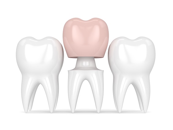 Reasons Why A Dental Crown Might Be Recommended