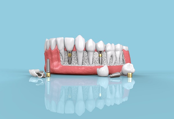 Dental Implants Southfield, MI
