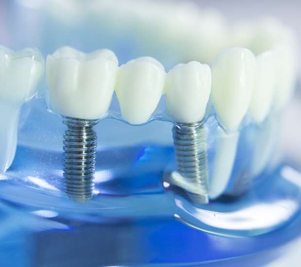 Southfield Dental Implants