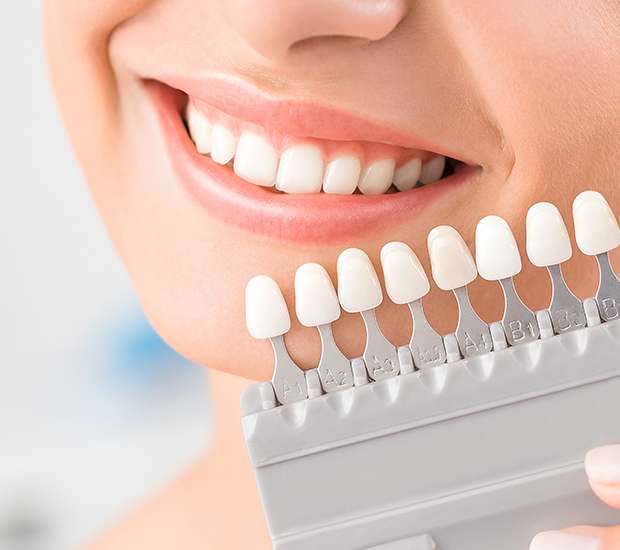 Southfield Dental Veneers and Dental Laminates