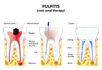 Root Canal Therapy